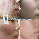 Yanhee Acne Cream 10 g