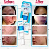 Yanhee Acne Cream 10 g